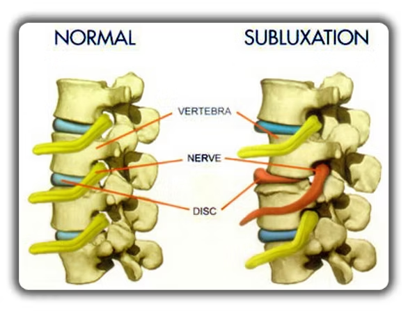 Diagram comparing a normal vertebra and nerve with a subluxated one, where the disc is compressed and the nerve is inflamed